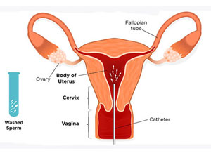 IUI - Intrauterine Insemination